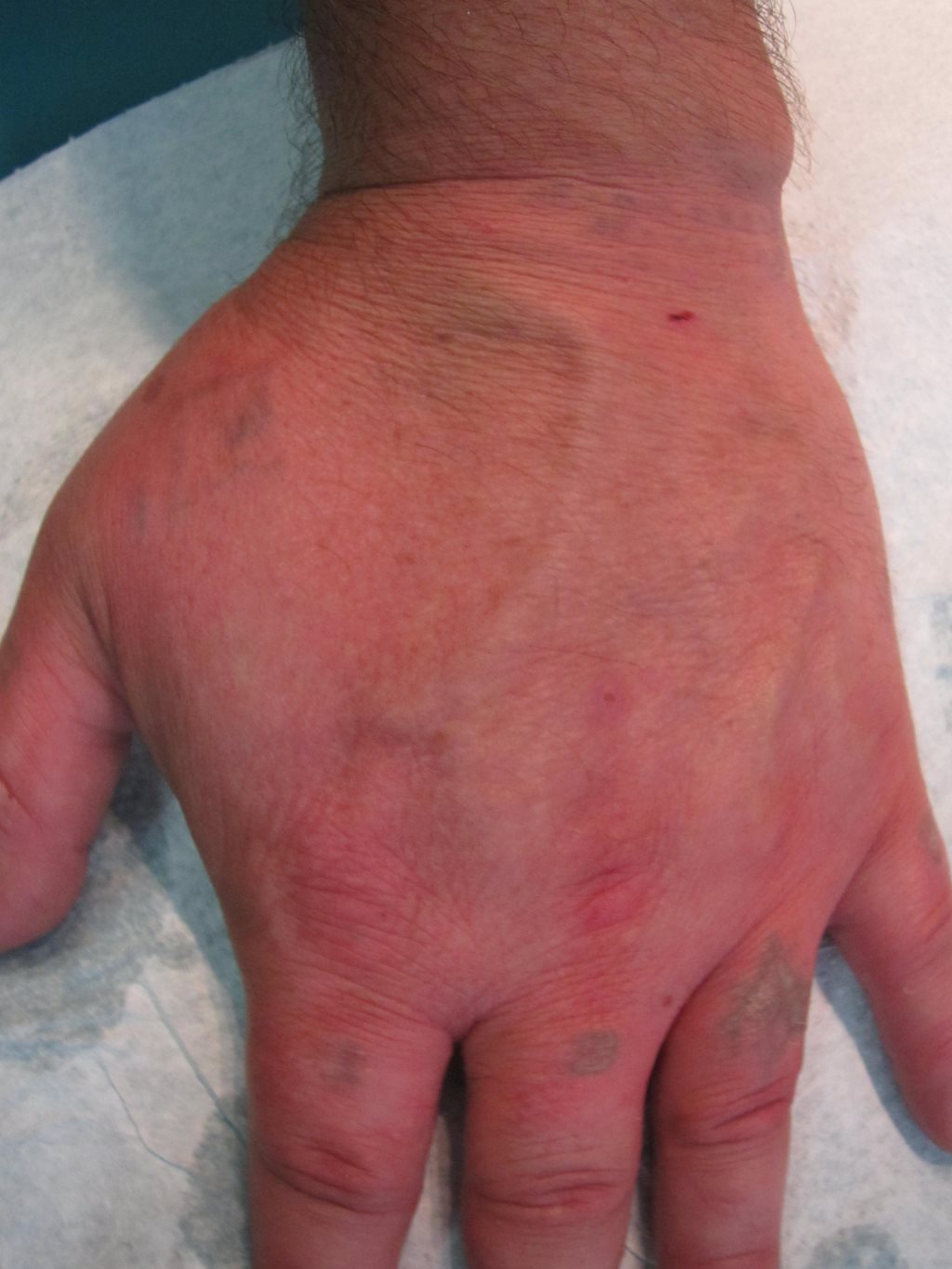 Finger Handgelenk Laser vorher nacher (11).JPG