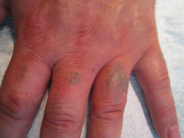 Finger Handgelenk Laser vorher nacher (16).JPG