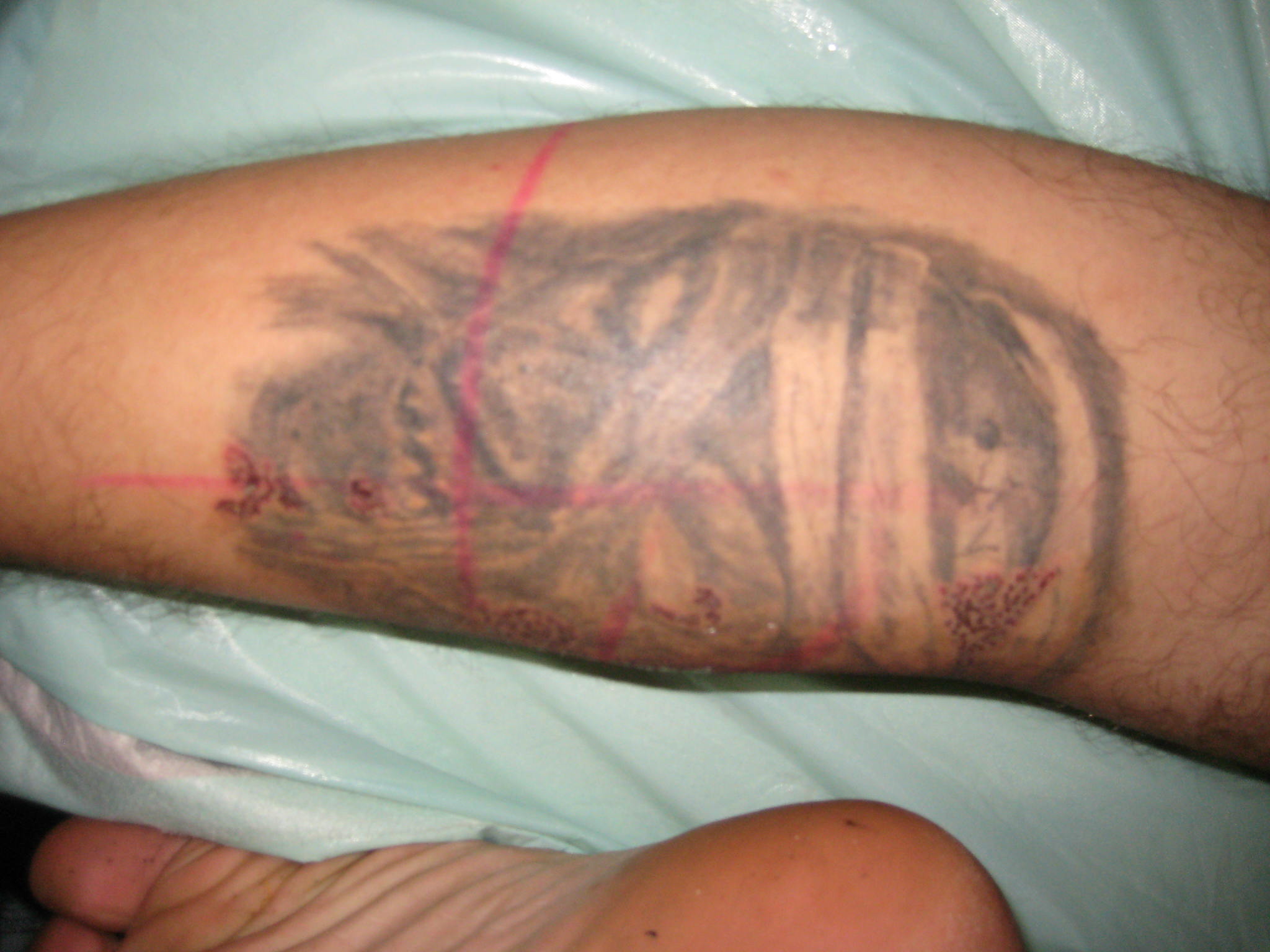 Gustavo Wade Tattoo Laser vorher nacher (8).JPG
